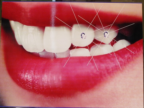 gems adhered to teeth