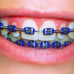 orthodontcs-and-braces