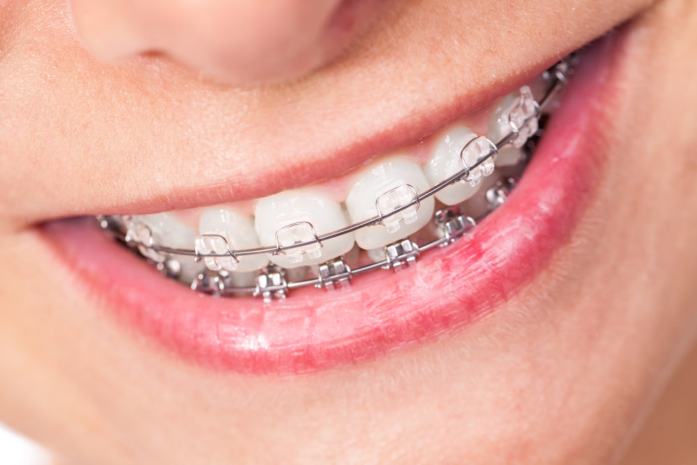 mouth braces