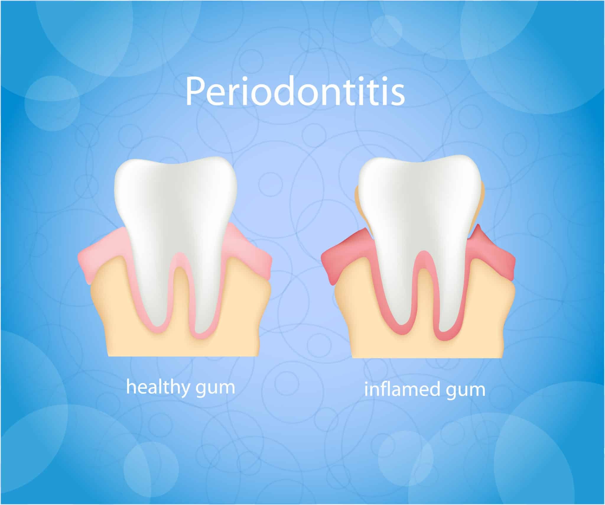 causes-of-gum-diseases-and-those-most-at-risk