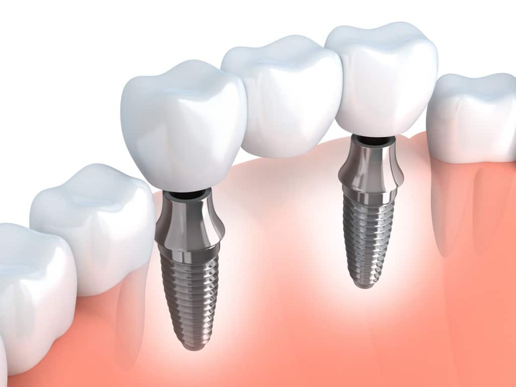 Three-tooth dental implant