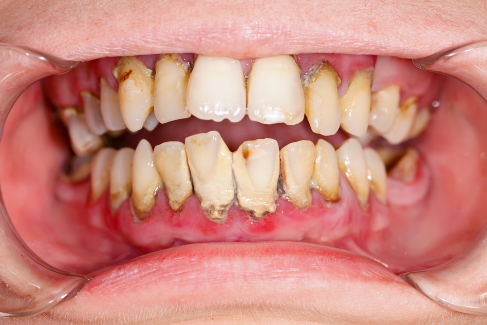 unhealthy teeth and gums
