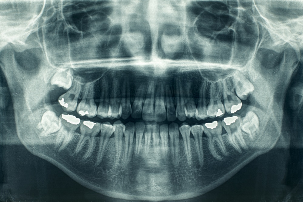 nasal septum radiograph