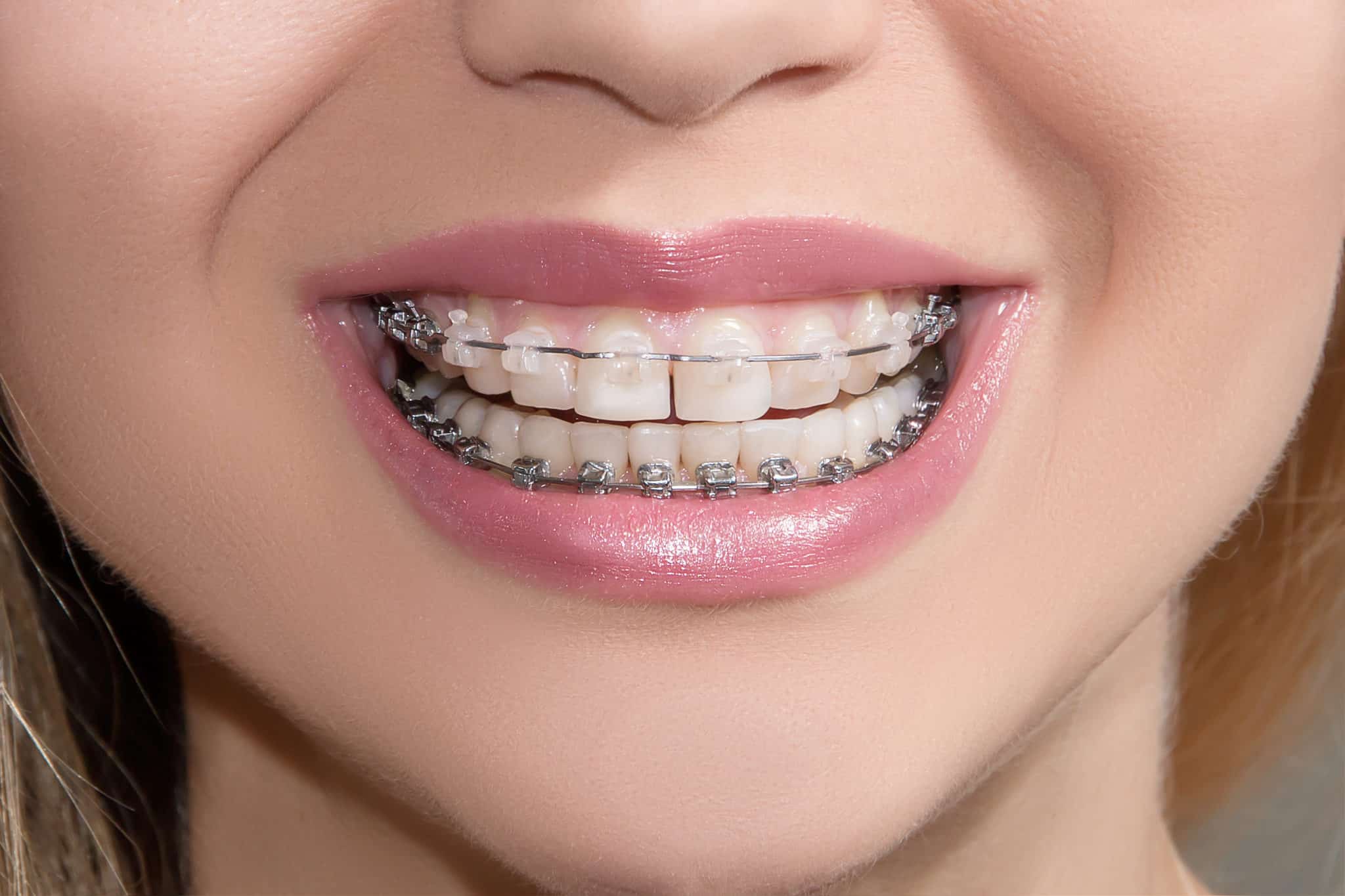 Removing White Spot Lesions after Orthodontic Braces
