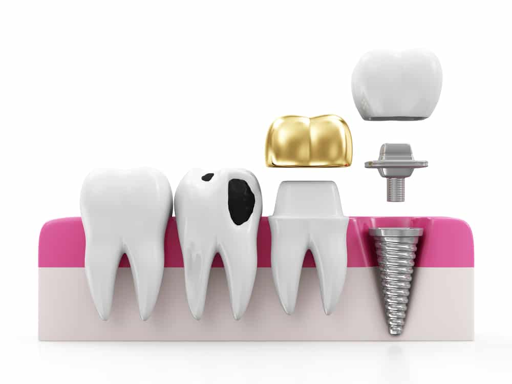 What To Do If Your Dental Crown Fell Out