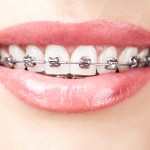 woman with braces