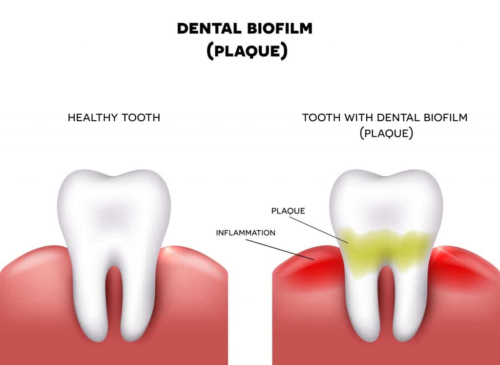 How to Remove Dental Plaque at Home  