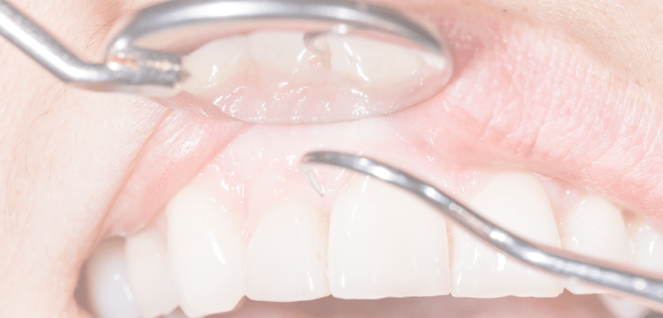 Dental Hygienist Explains Deep Cleaning Procedure 