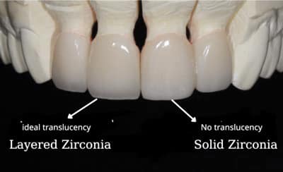 Layered and Solid Zirconia crowns side by side to see differences in transparency. 