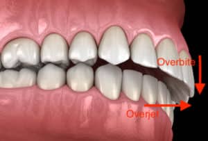 How to Fix an Overbite: Causes and Corrections - BDG