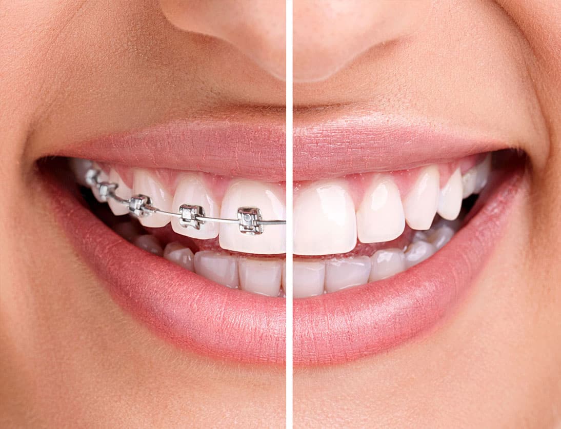 Where to Get Cheap Braces? — Dental Savings Plans Overview