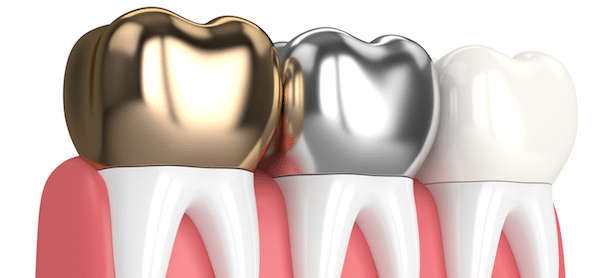 Types of Dental Crowns Las Vegas