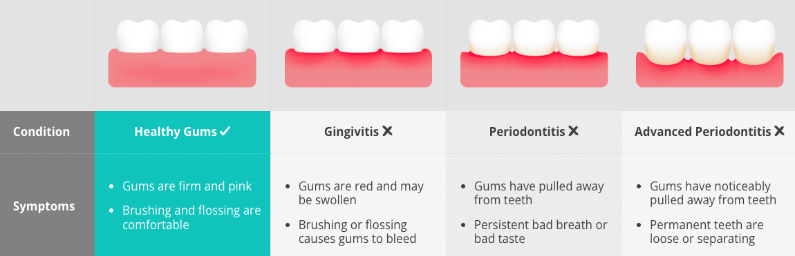 gingivitis vs periodontal disease