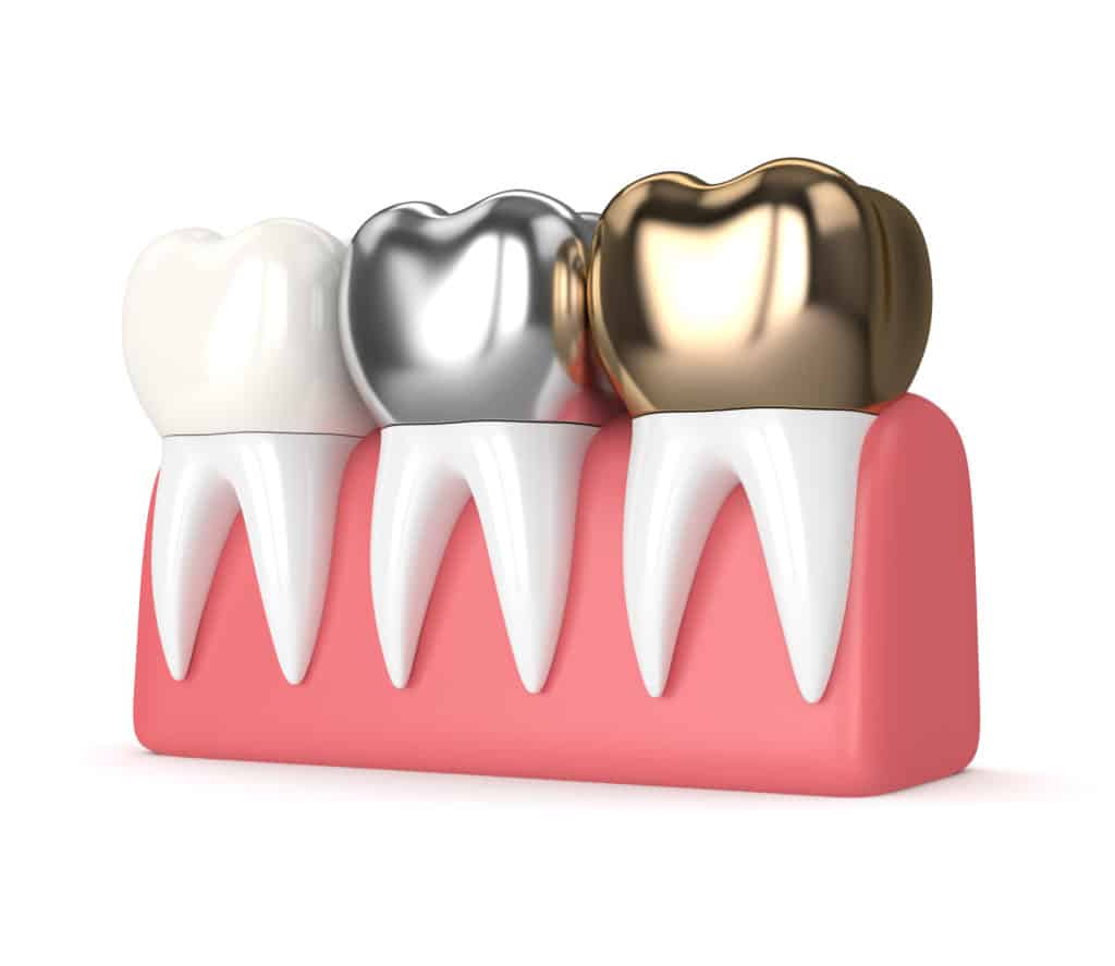 types of dental crowns, including ceramic or porcelain, steel, and gold