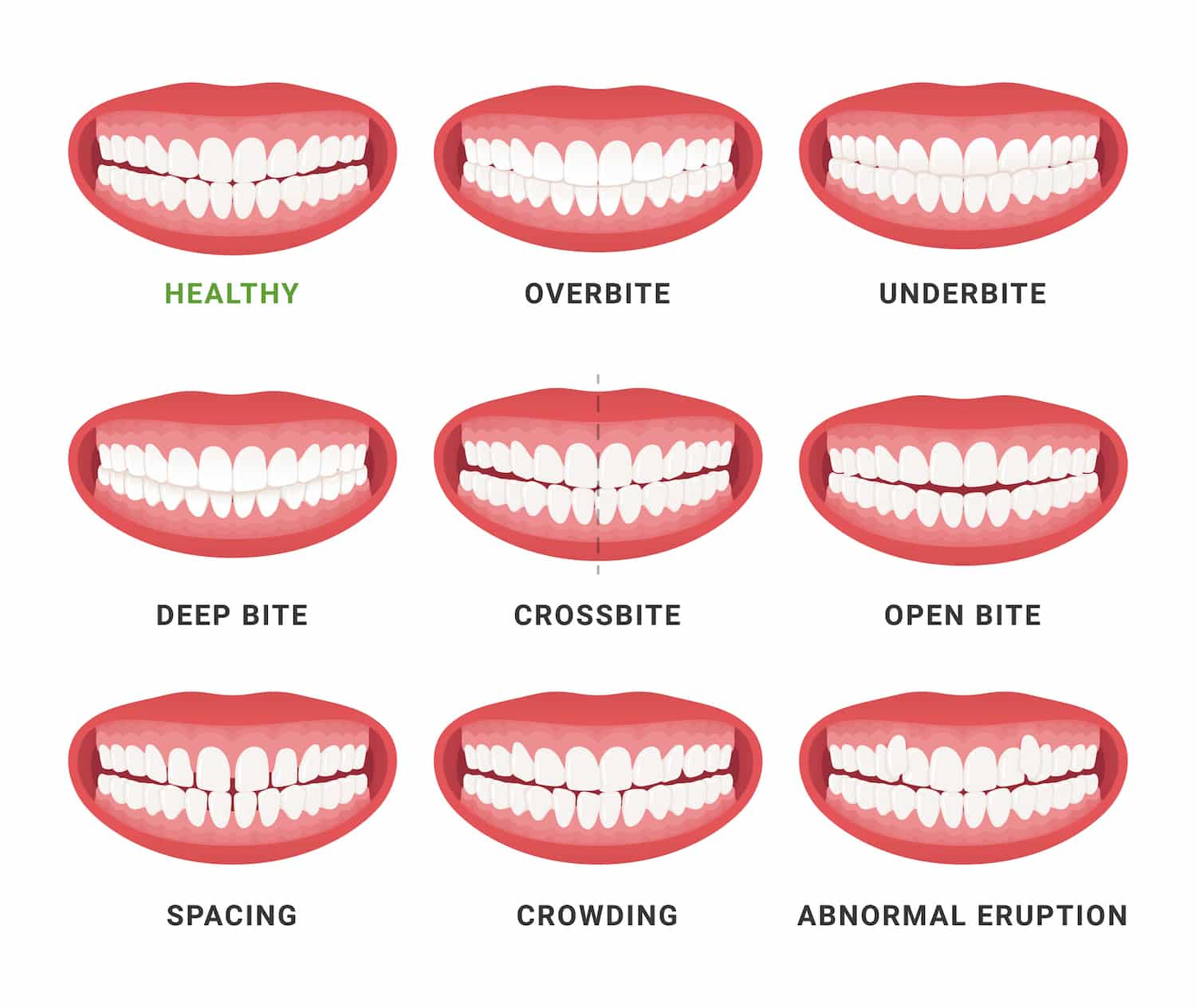 Underbites: What Are They and Can They Be Corrected? - BDG