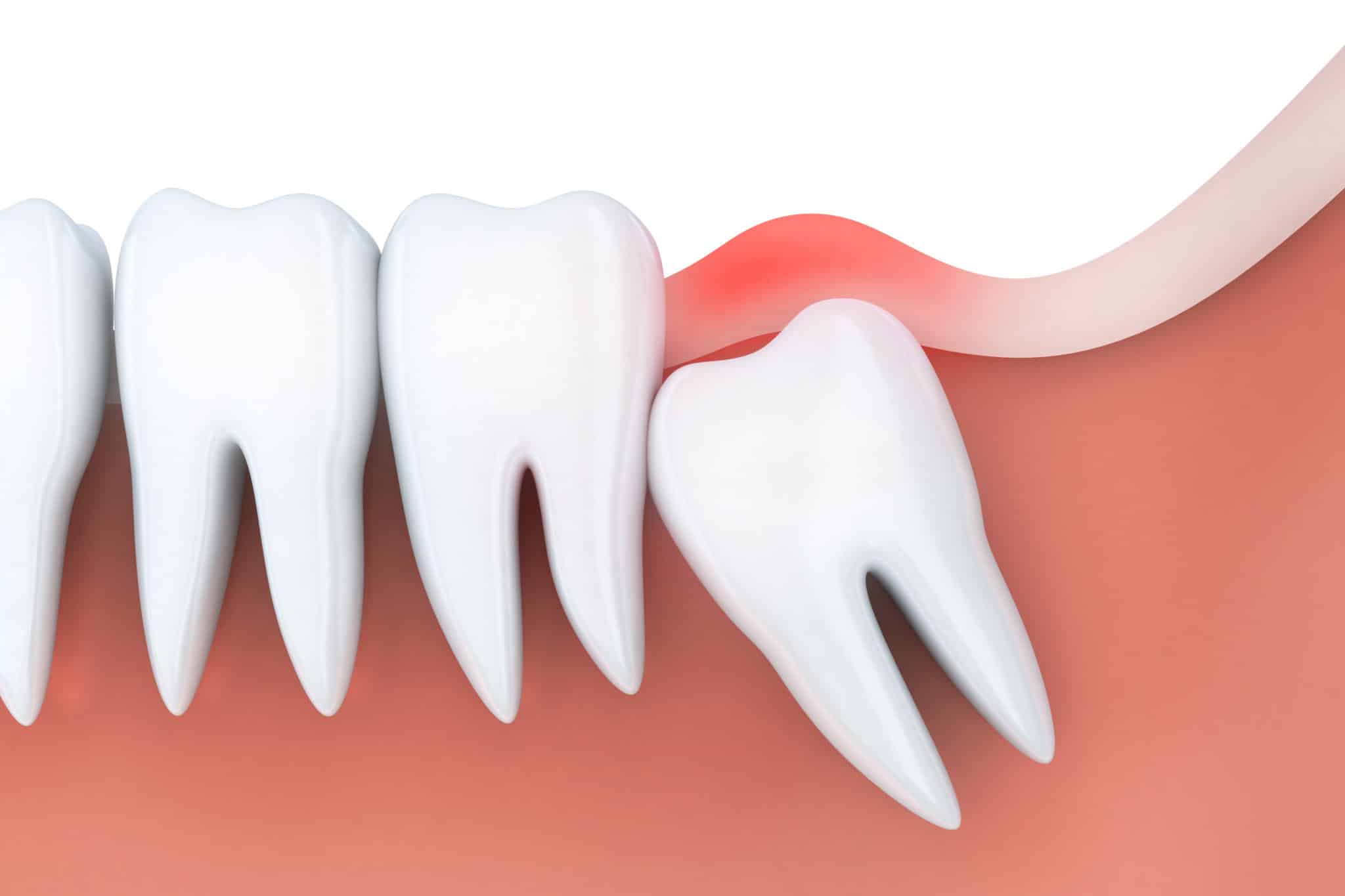 Why Do We Get Dry Sockets and How Do We Treat Them? - All Out Wisdom Teeth